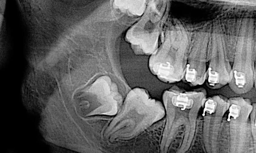 HOW YOUR 12 YEAR MOLARS AFFECT YOUR ORTHODONTIC TREATMENT