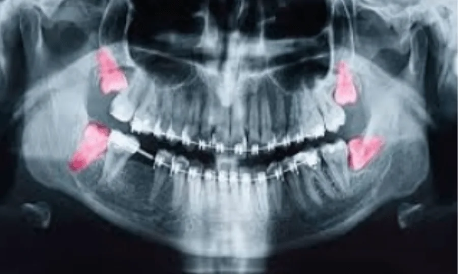 Braces And Wisdom Teeth