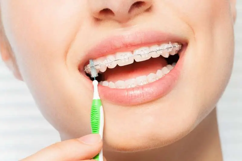 TIPS TO PREVENT TOOTH DECAY WITH BRACES