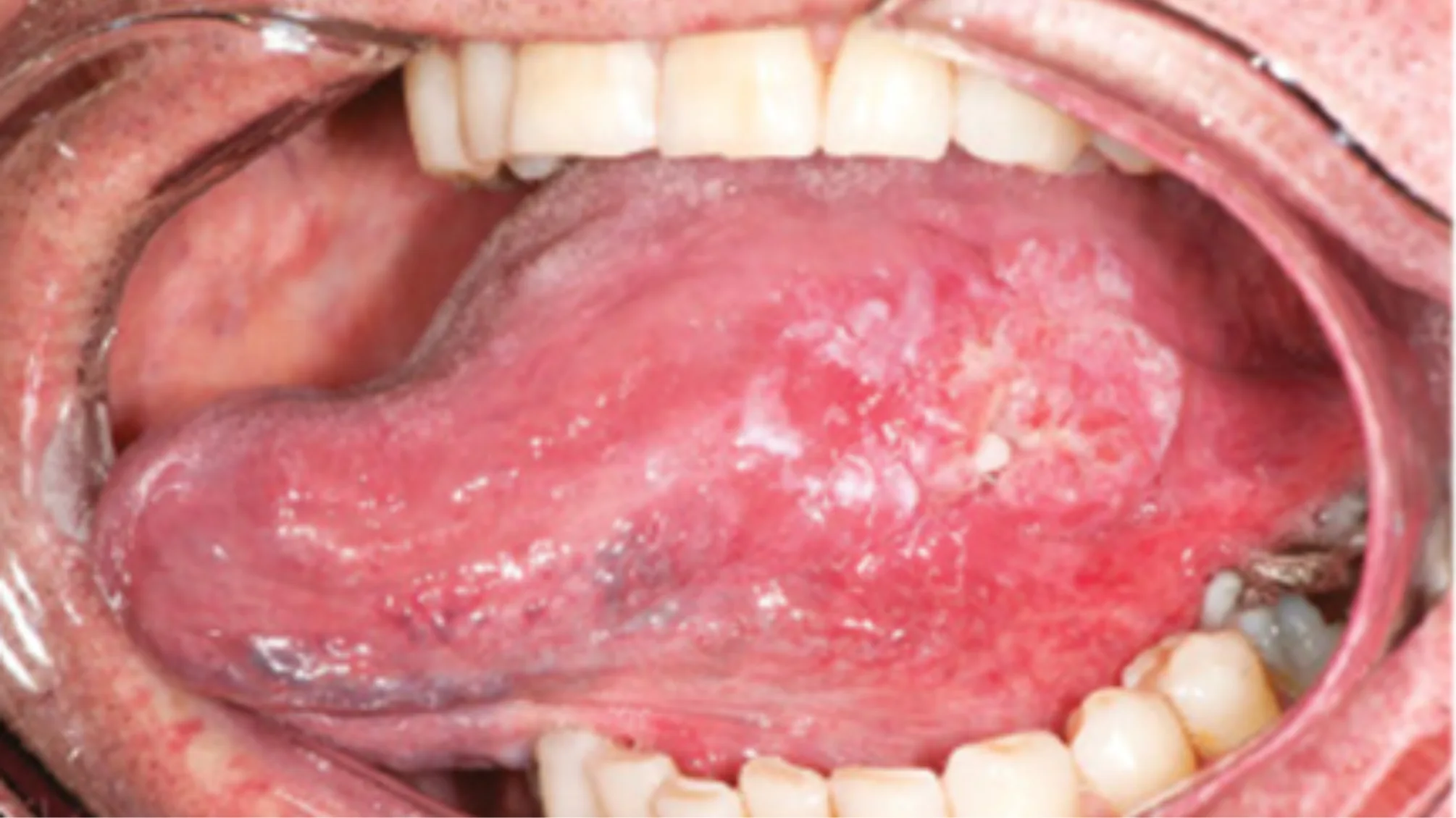 Oral Cancer & Pre-Cancer  :  Signs & Symptoms