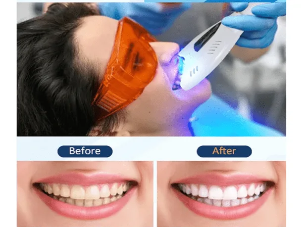 4 BEST COSMETIC DENTAL TREATMENTS