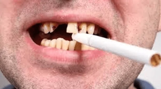 Effects of smoking on oral health
